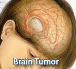 Brain Tumor