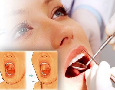 Low Cost Mouth Cancer Treatment