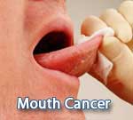 Mouth Cancer