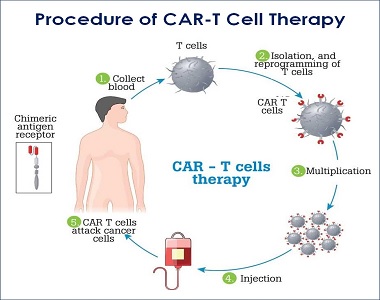 Procedure car-t-cell therapy india