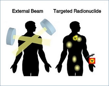 radionuclide treatment for cancer  
in india 