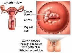 Treatment Cervical Cancer India